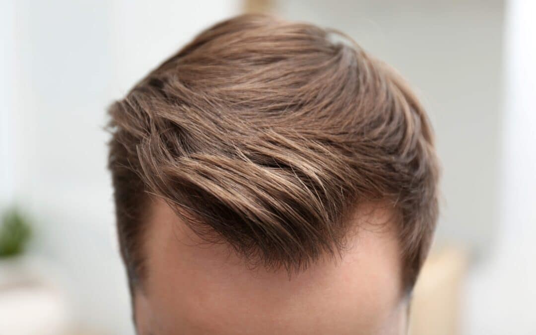 New to Wigs? Mastering Glued Hair Systems Wear Time