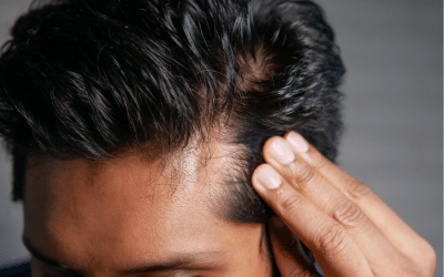 Best Hair System Adhesive for Oily Skin: What Actually Works?