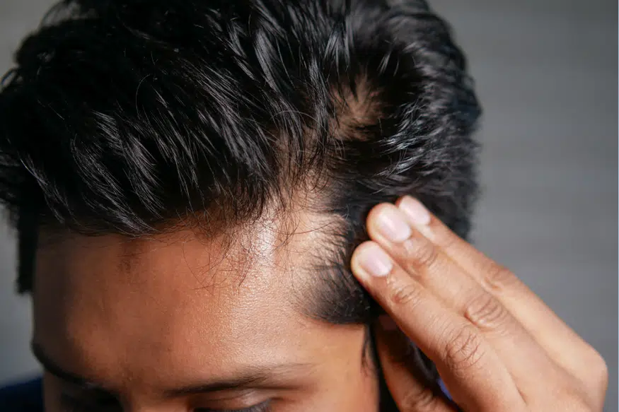 Best Hair System Adhesive for Oily Skin: What Actually Works?